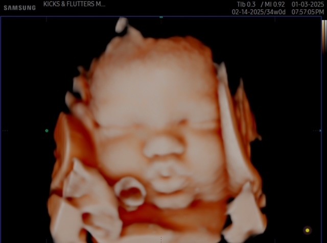 3D ultrasound of a baby during an at home ultrasound in Nashville