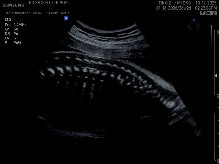 ultrasound image of fetal spine