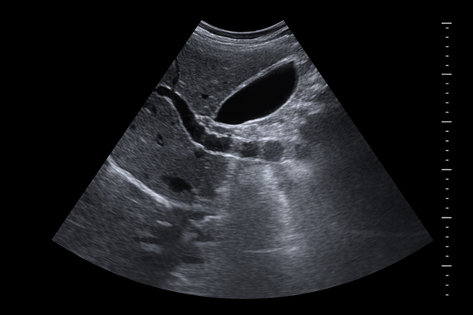 ultrasound image of gallbladder and liver