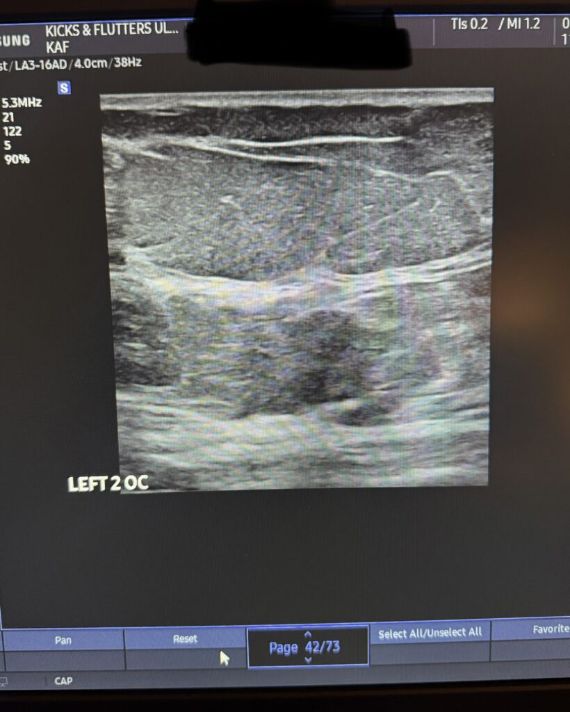 Can I Get a Breast Ultrasound Without a Mammogram? 2 Breast ultrasound Middle TN and Southern KY