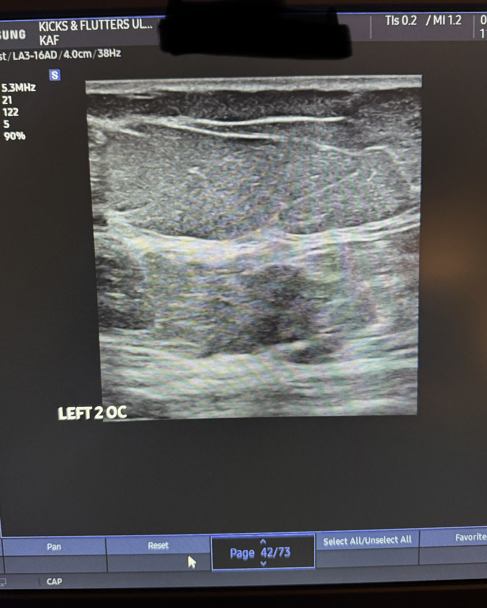 At Home Breast Ultrasound in Nashville, TN 2 IMG 69761