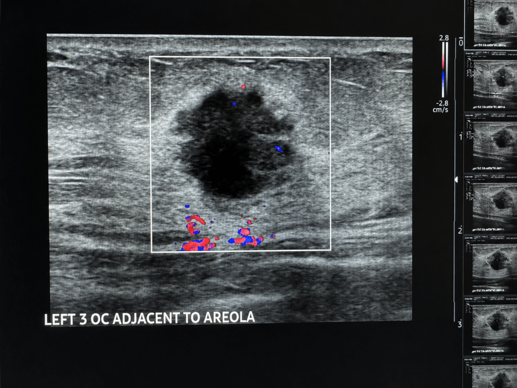 Can I Get a Breast Ultrasound Without a Mammogram? 5 F9B239A3 A563 4EBB B8DB 50BB0F65CEDF