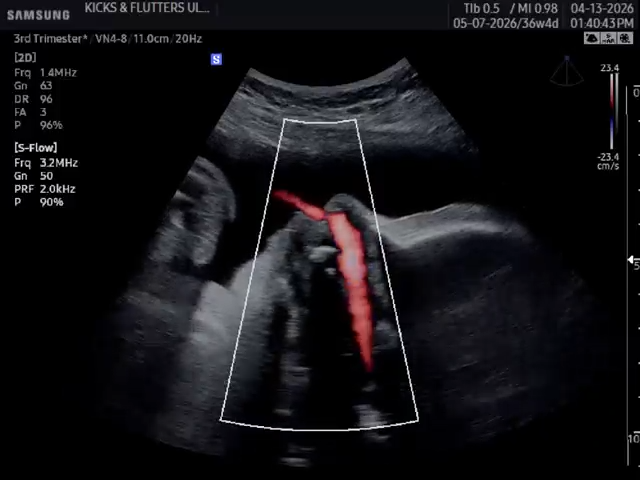 Biophysical profile Ultrasound | BPP